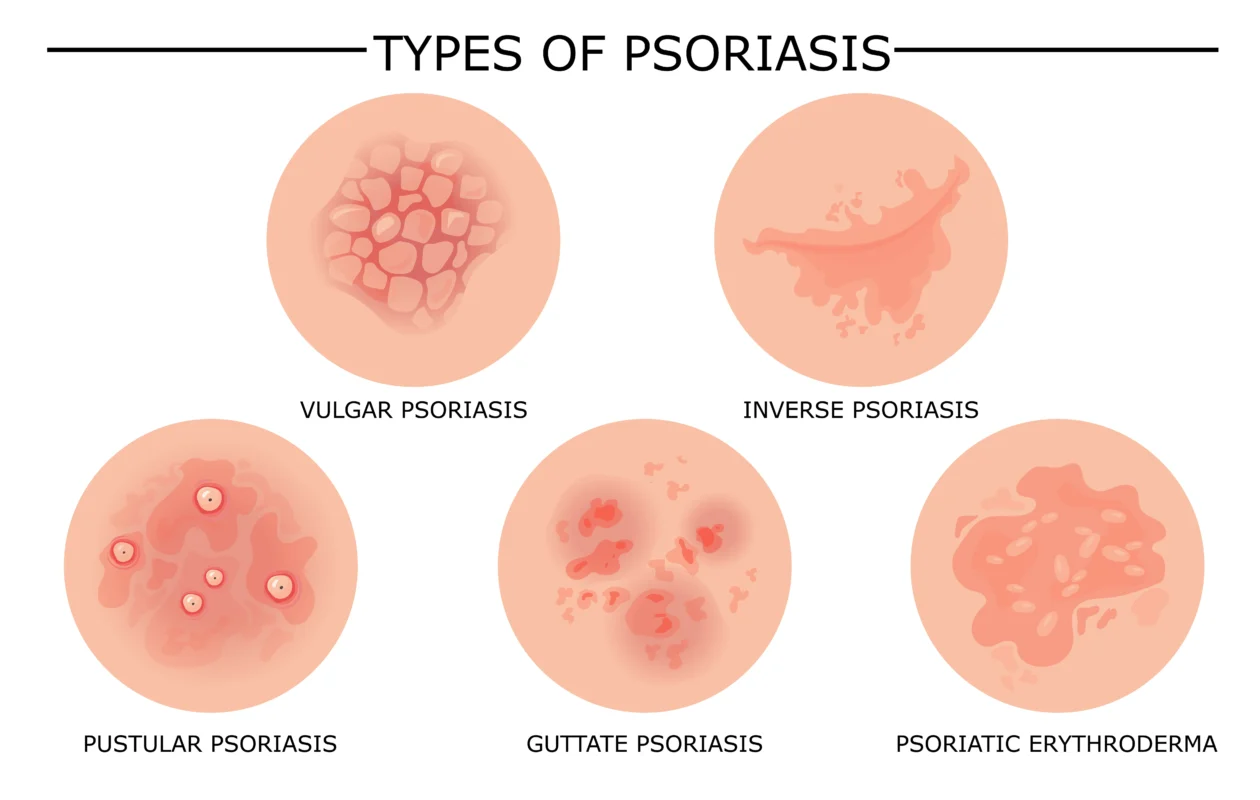 types of psoriasis