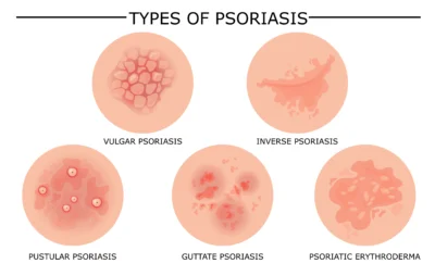 types of psoriasis