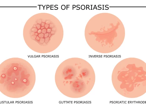 13683159 Different types of psoriasis vector set scaled