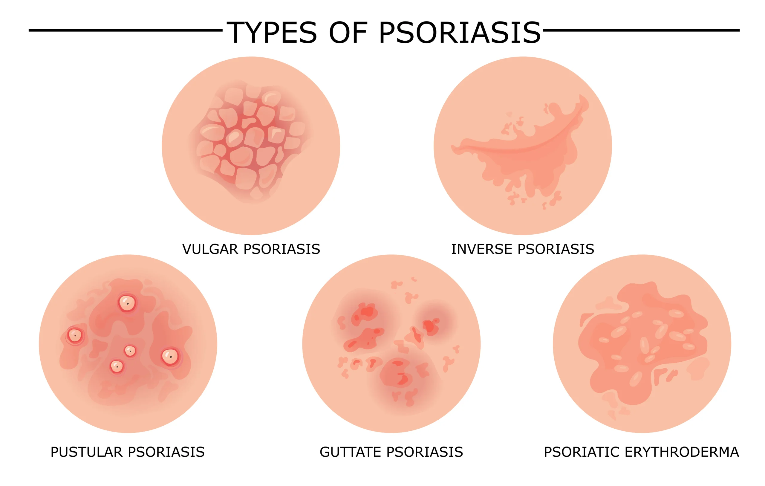 types of psoriasis