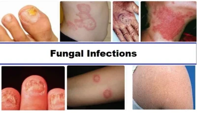 Fungal-infections of skin