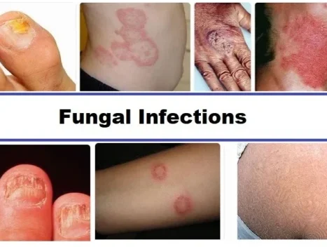 Fungal infections featured e1752474090761