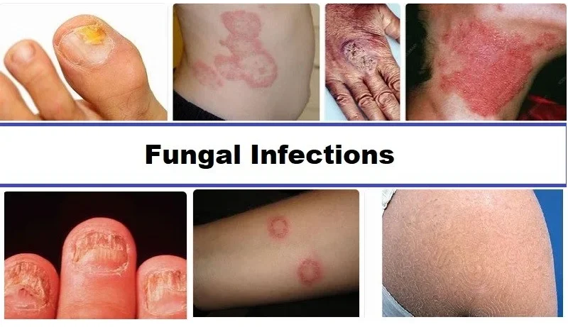 Fungal-infections of skin