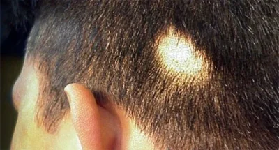 alopecia aretata