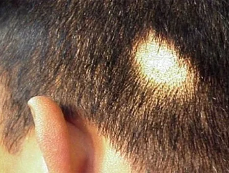 alopecia aretata