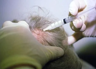 alopecia treatment