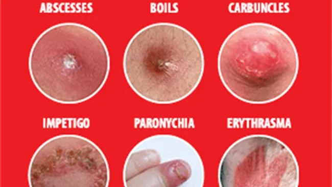 bacterial skin infections edited