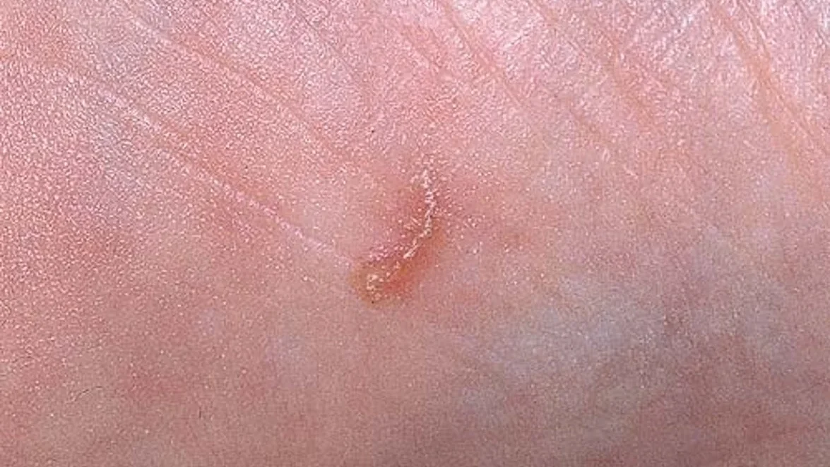 scabies burrows