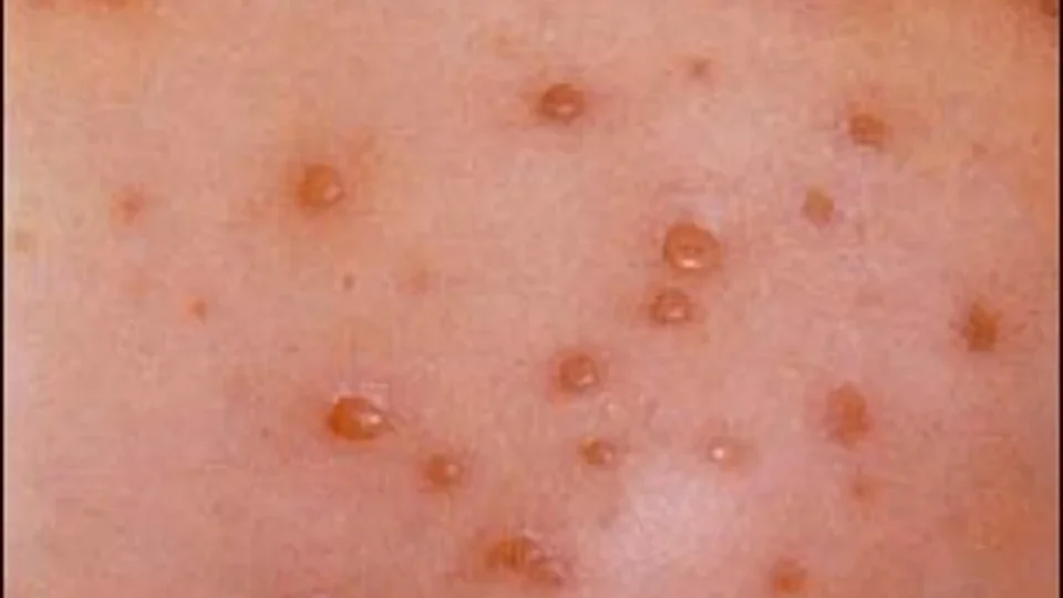 chicken pox edited