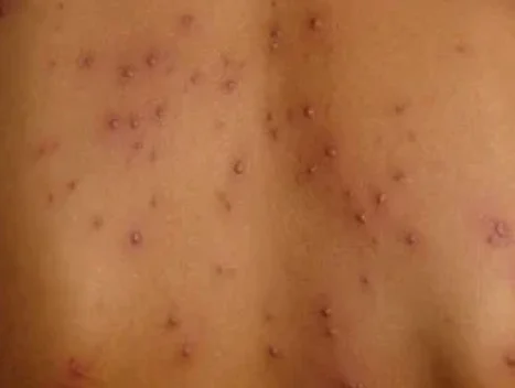 chickenpox e1752231224460