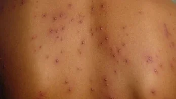 chickenpox