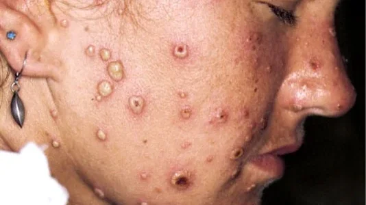 chickenpox polymorphism