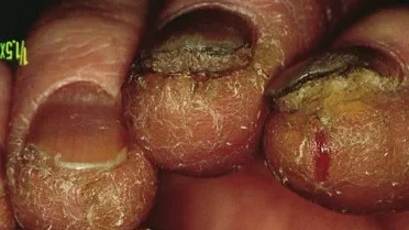 eczema nail change edited