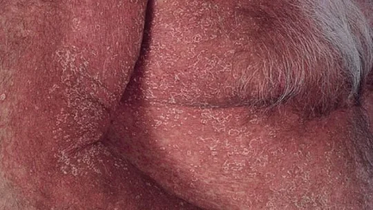 erythmatous psoriasis edited