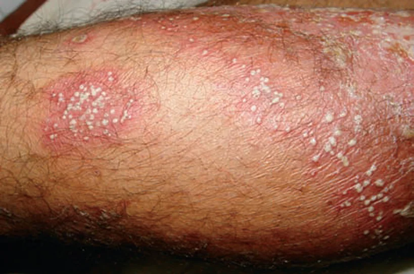 guttae psoriasis
