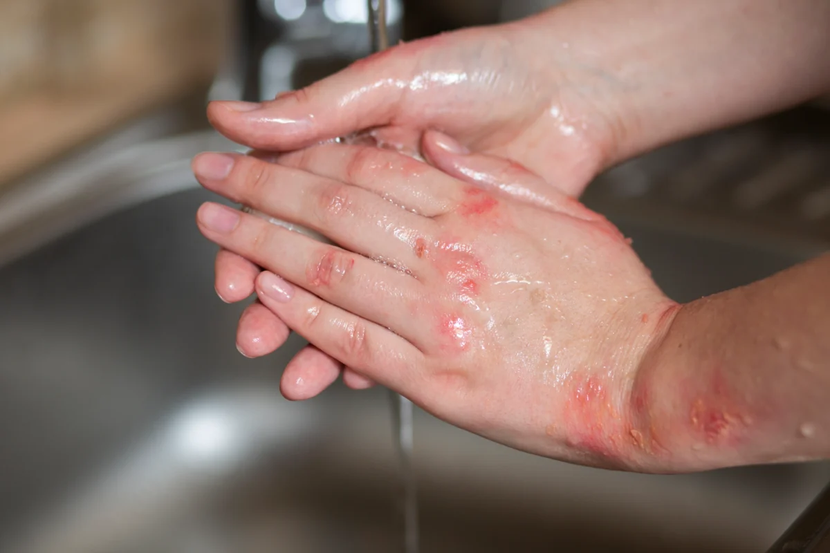 hands patient suffering from psoriasis 1