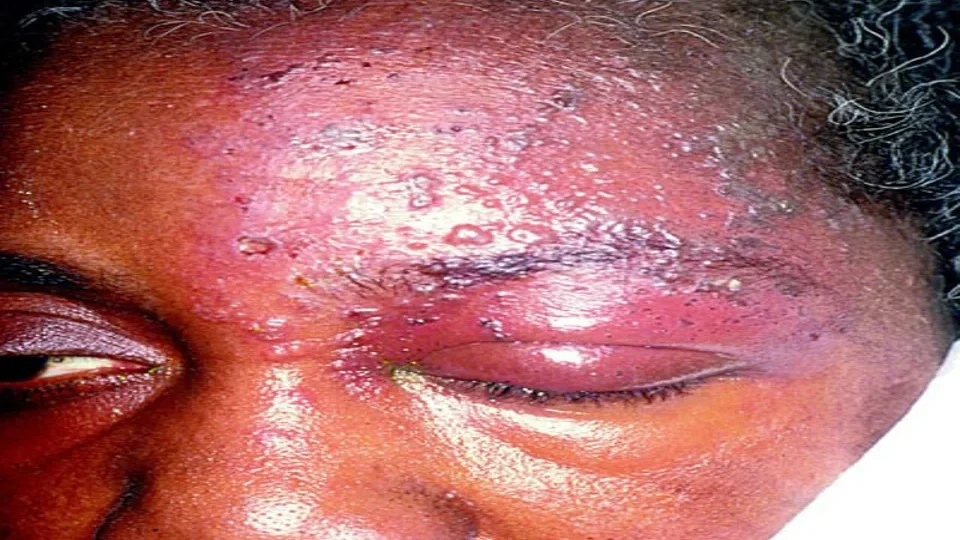 herpes zoster edited