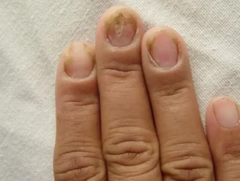 nail disease e1752230116174