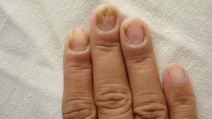 nail disease e1752230116174