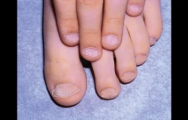 nails in alopecia