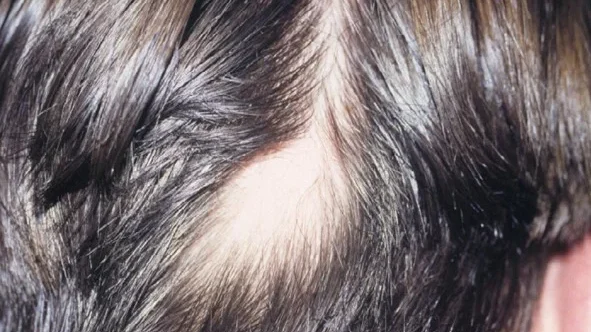 patchy hair loss edited