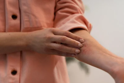 scabies