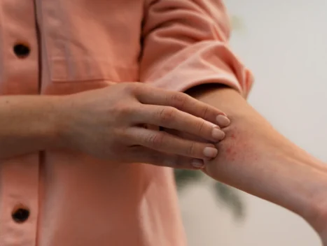person dealing with rosacea 2 scaled
