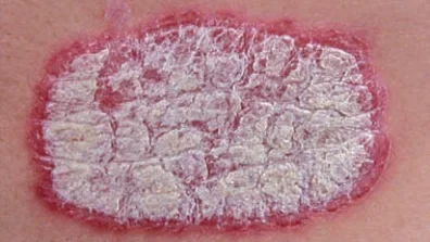 plaque psoriasis edited