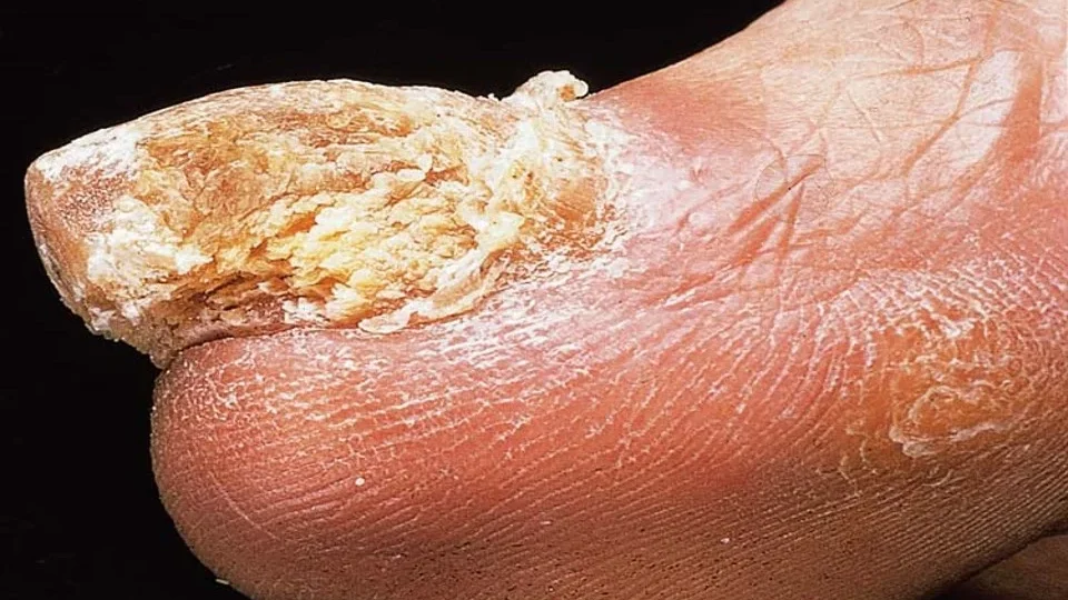 psoriasis nail change edited