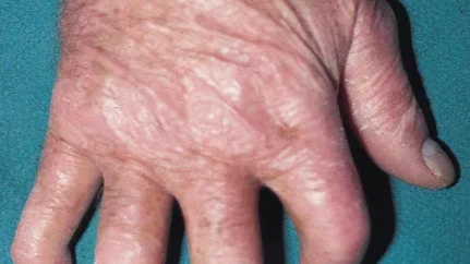 psoriatic arthritis edited