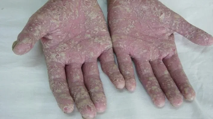 pustular psoriasis edited