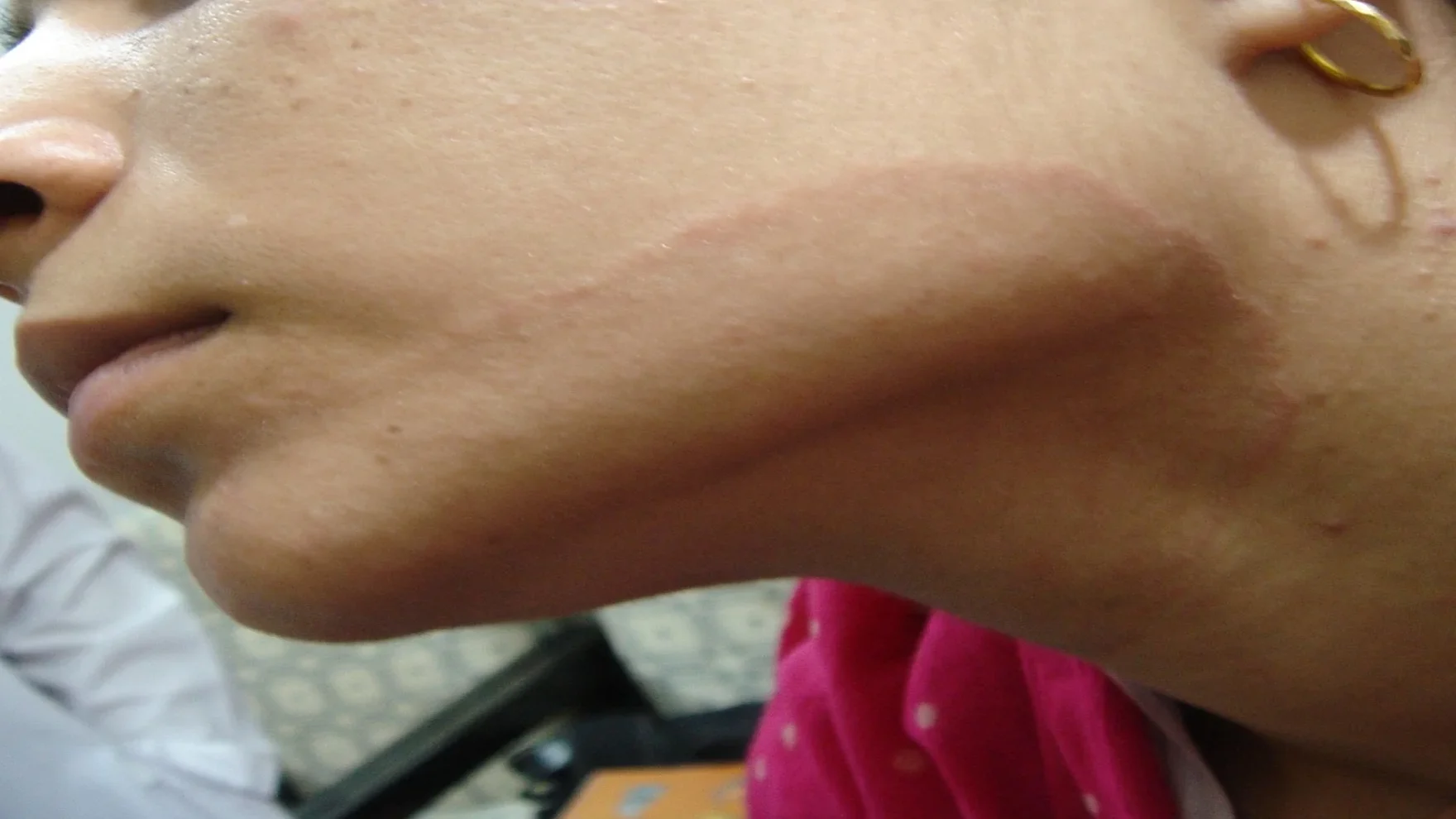 ringworm of face