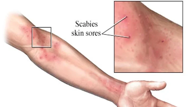 scabies picture edited