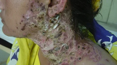 superadded bacterial infection