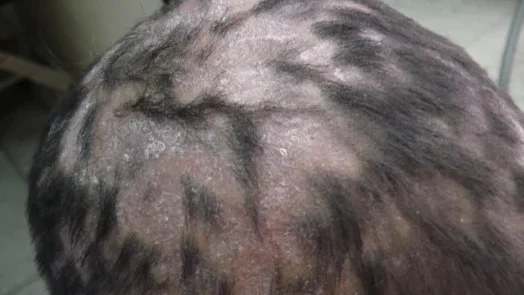 tinea capitis