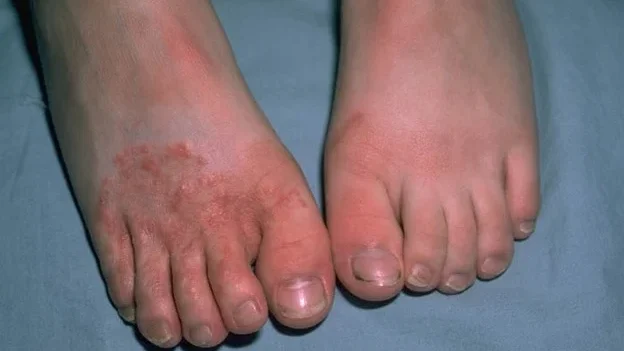 tinea pedis