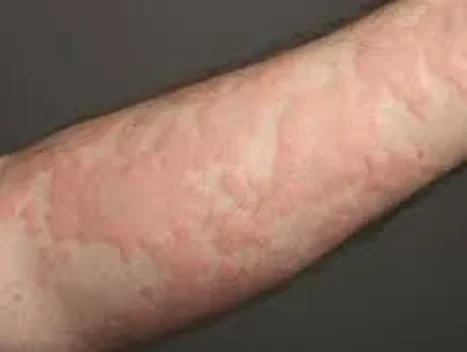 urticaria featured image