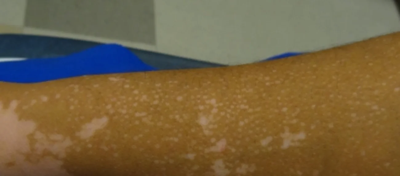 vitiligo