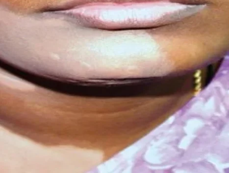 vitiligo featured image