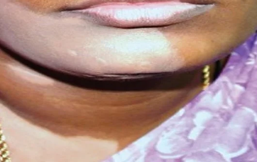vitiligo
