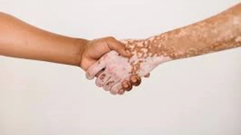 vitiligo image 1 edited
