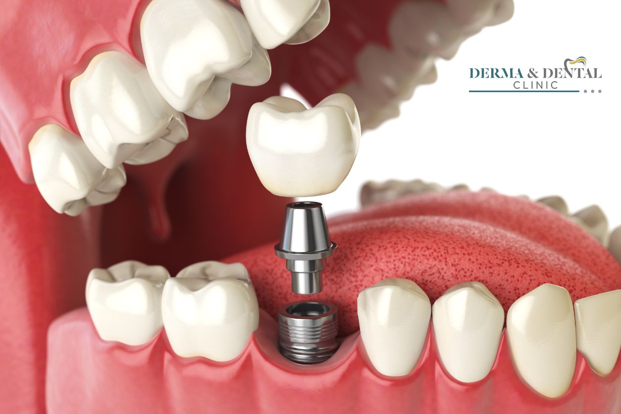 Root canal