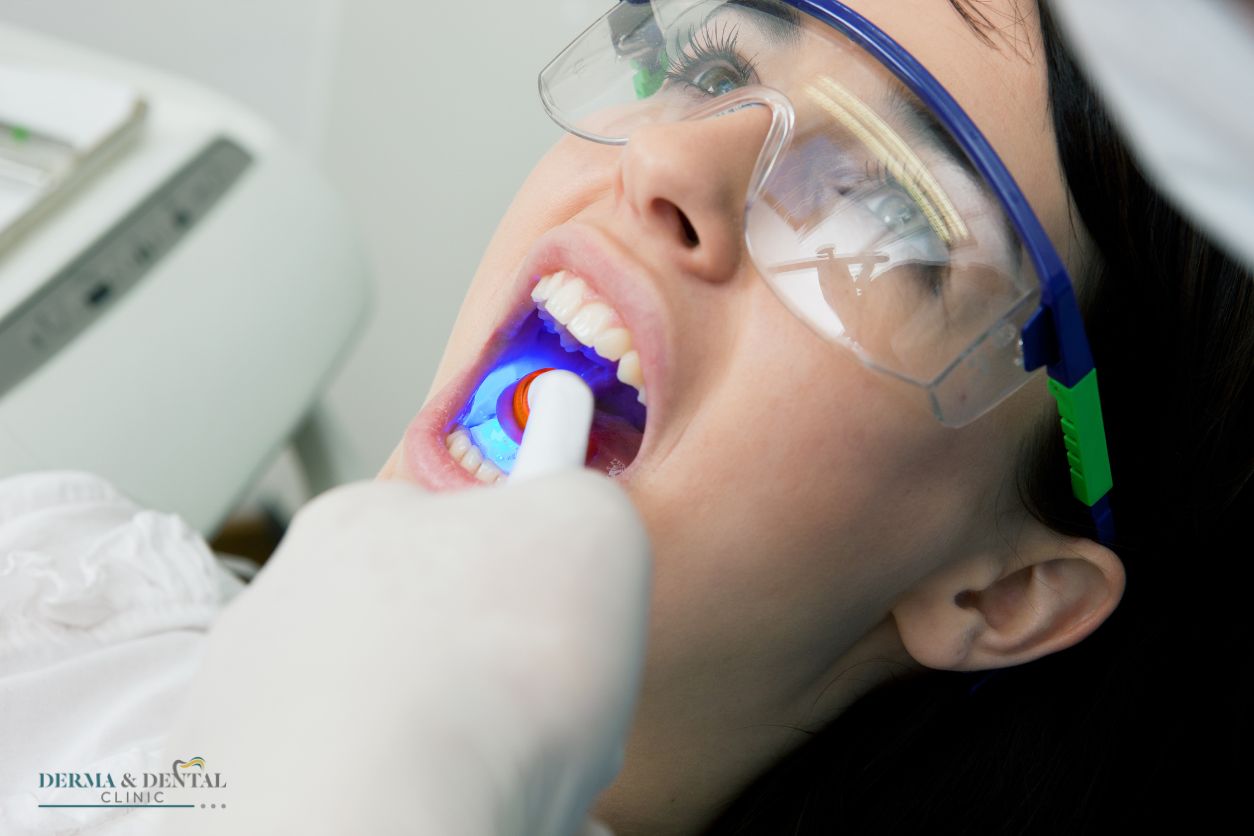 composite filling