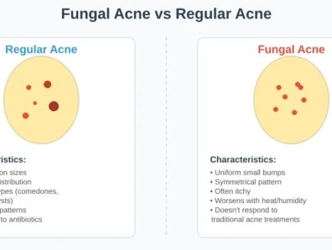 fungal vs regular acne