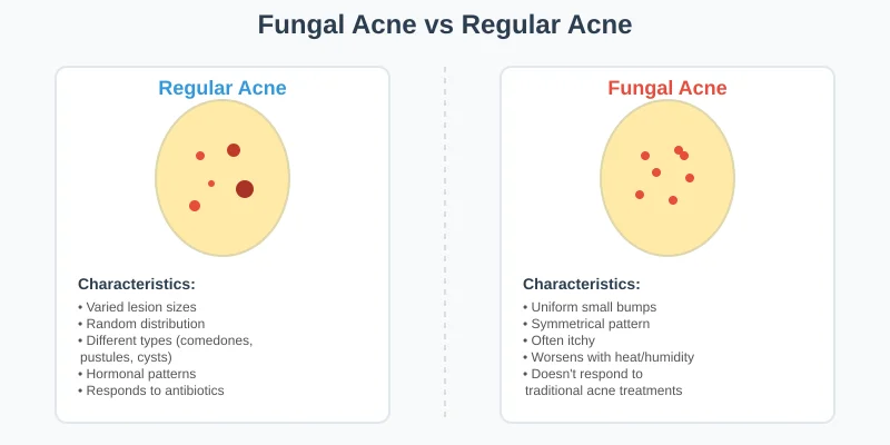 fungal vs regular acne