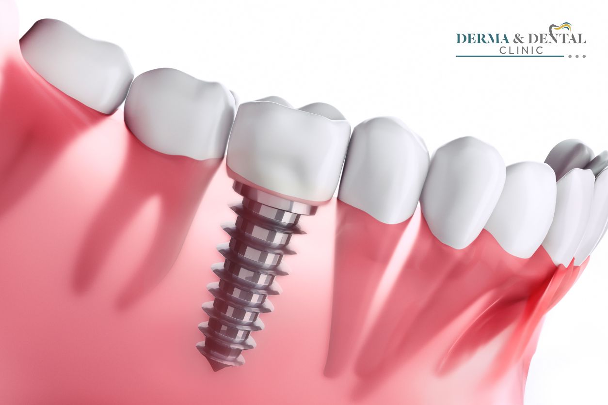 implant